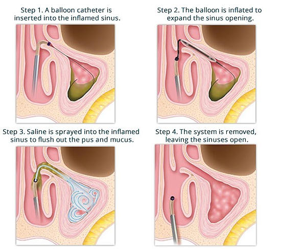 Balloon Sinuplasty