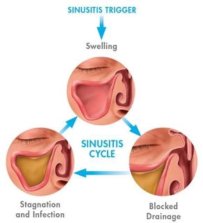 Sinusitis