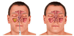 Sinuplasty